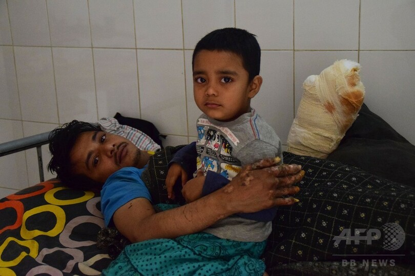 「樹木男」のイボ再発、25回目の手術 将来に不安