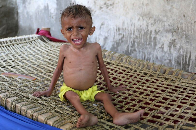 内戦下のイエメンでコレラ発生、子供たちに命の危機 ユニセフ警鐘