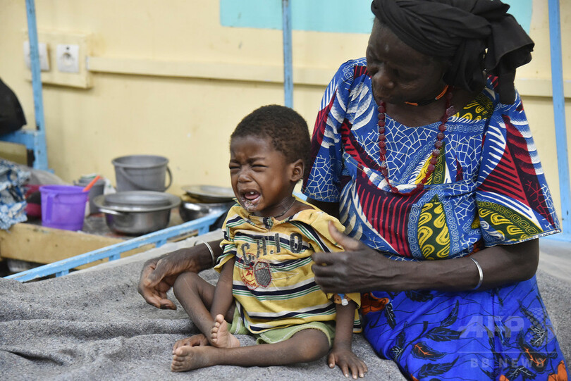 壊疽性口内炎、栄養失調の子どもに広がる恐怖 ニジェール