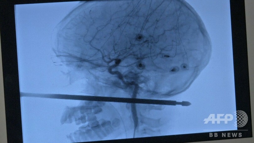 ツリーハウスから転落し金串が頭部ほぼ貫通、脳に損傷なし 米10歳児