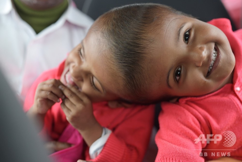 バングラの頭部結合双生児 30時間に及ぶ分離手術が成功 写真6枚 国際ニュース Afpbb News