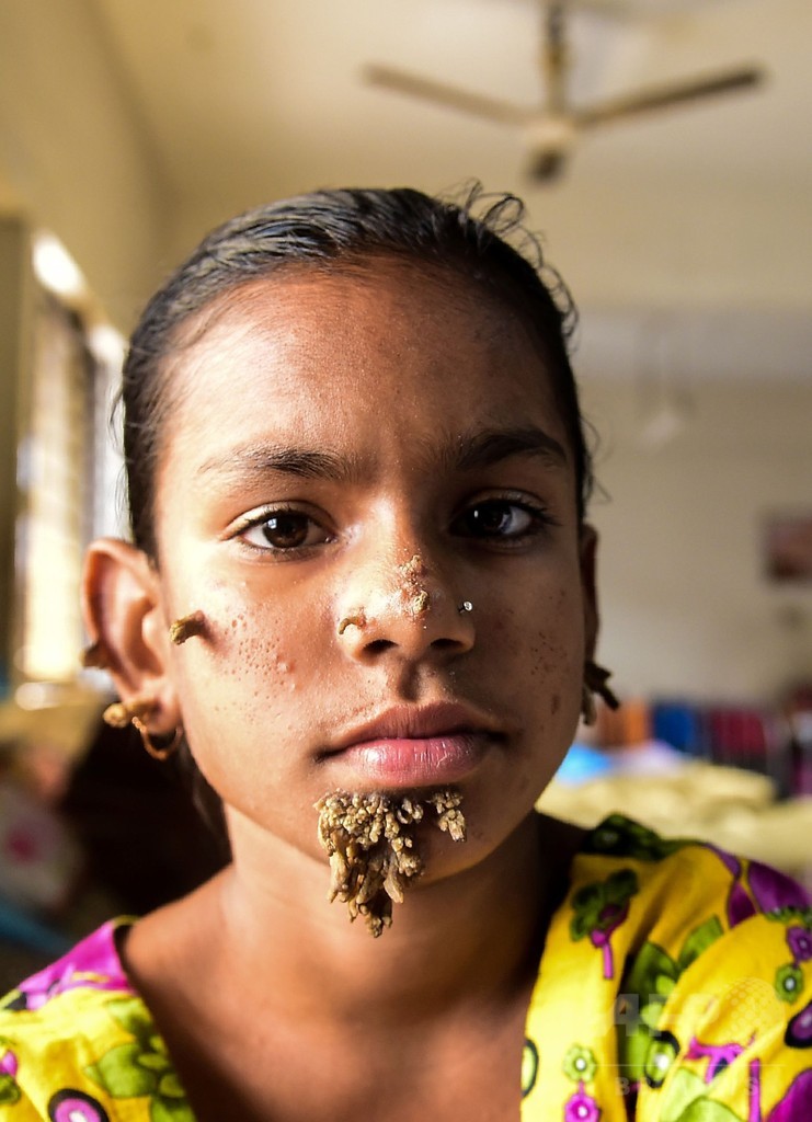 バングラの少女、女性として初めて「樹木男症候群」発症か 写真5枚 国際ニュース：afpbb News 