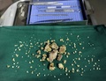 インド・ムンバイ（Mumbai）の病院で行われた少年の複雑性歯牙腫（しがしゅ）手術で、摘出された歯の組織（2014年7月22日撮影）。(c)AFP