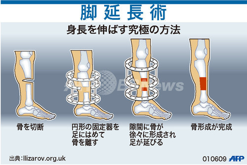 図解 身長を伸ばす究極の方法 脚延長術 写真1枚 ファッション ニュースならmode Press Powered By Afpbb News