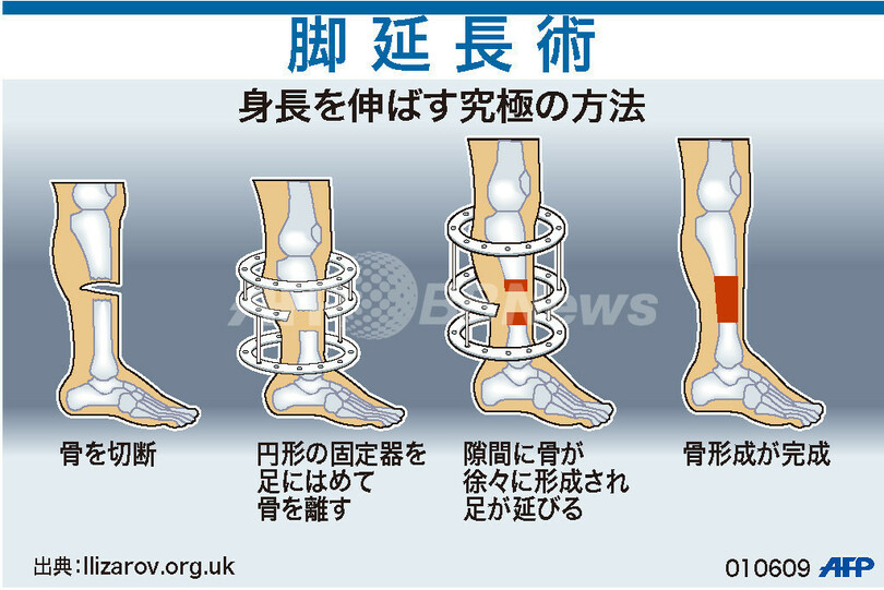 図解 身長を伸ばす究極の方法 脚延長術 写真1枚 国際ニュース Afpbb News