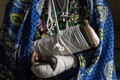 コンゴ民主共和国北東部イトゥリ州ブニアの病院に入院中のアルフォンシーヌ・モジェタさん（54）。住んでいた村が襲撃され、子ども2人を失い、自分も山刀で切りつけられ後頭部、腕、手に重傷を負った。茂みの中に2日間隠れた後、助けを求めてブニアにたどり着いた（2018年3月2日撮影）。(c)AFP / John Wessels