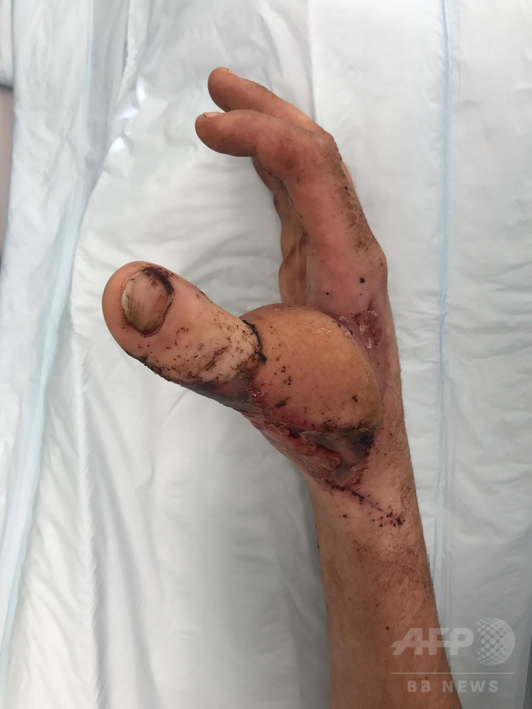 手の親指切断の豪男性 手術で足の親指を手に移植 写真3枚 国際ニュース Afpbb News