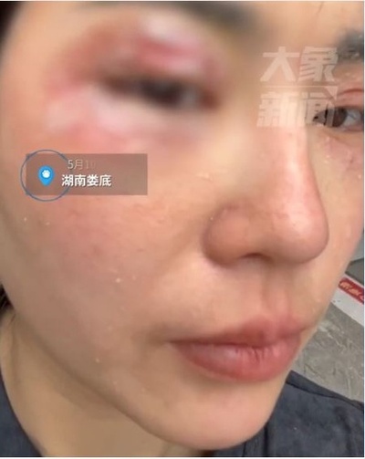 飛べる硫酸？ この毒虫に警戒すべき すでに活発期に！ 中国