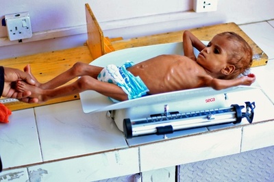 イエメン、1200万人に食料危機 「世界最悪の飢餓」に直面