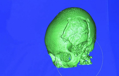 タリバンが銃撃の少女、頭蓋骨にチタン製板埋め込みへ