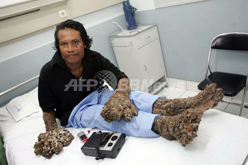 インドネシアの「樹木男」、9回目の手術 イボの成長止まらず インドネシアの「樹木男」、9回目の手術 イボの成長止まらず