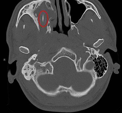 頭から鉛筆摘出、刺さったのは15年前？ドイツ