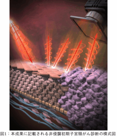 深部異形成を非侵襲に捉える円偏光散乱(CiPLS)イメージング ―子宮頸がん前駆病変の非侵襲診断に向けて―（北里大学）