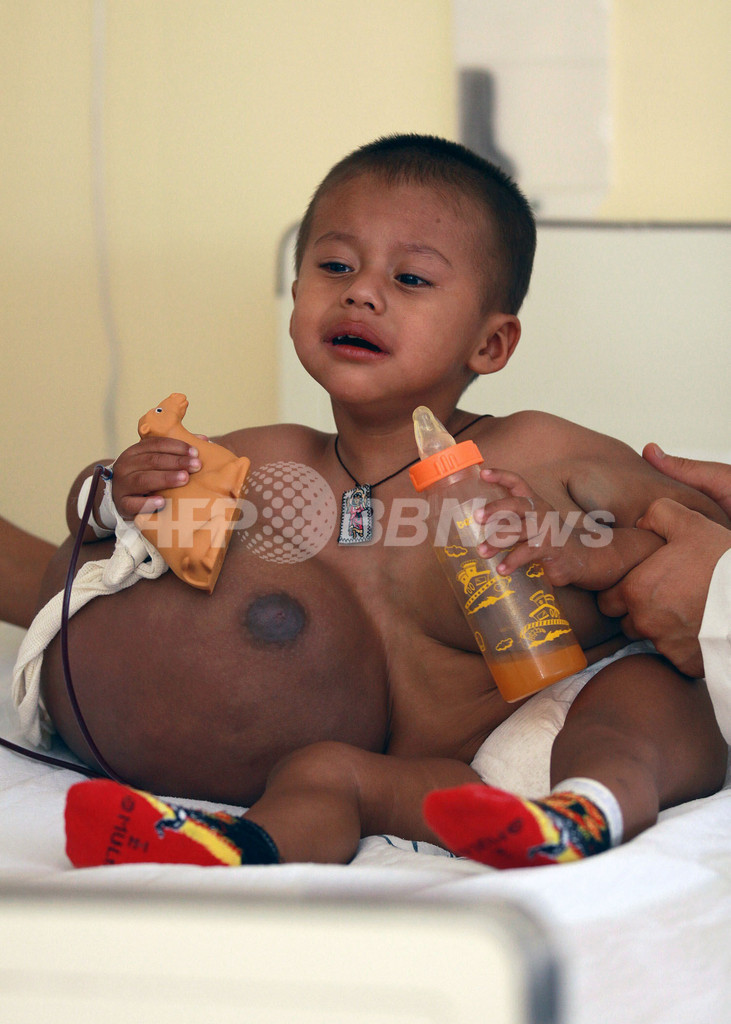 2歳児の体から15キロの腫瘍を切除、歩けるまで回復