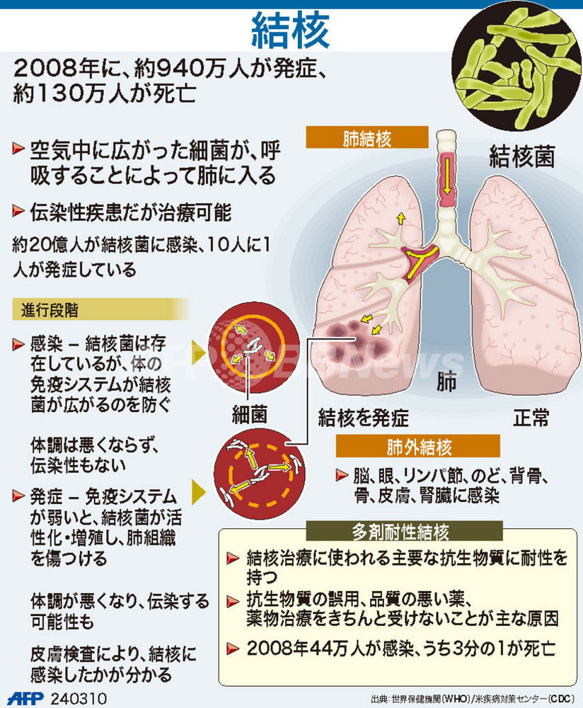【図解】結核 写真1枚 国際ニュース:AFPBB News