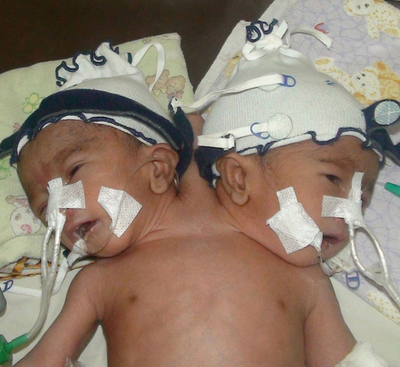 結合双生児、生後5日で死亡 インドネシア