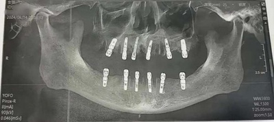 男性が1日に23本の歯を抜いて13日後に死亡　中国