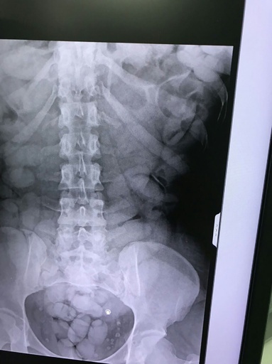 腹部内に薬物入りの包み隠す、コートジボワール人の女逮捕 タイ