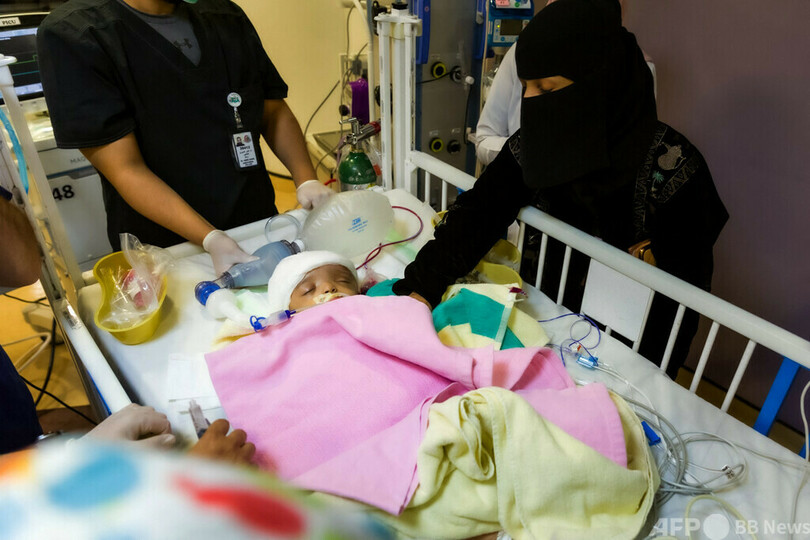 イエメンの結合双生児、分離手術成功 サウジ医師団