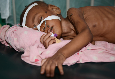 ソマリアの子ども20万人に餓死の恐れ、ユニセフが警鐘
