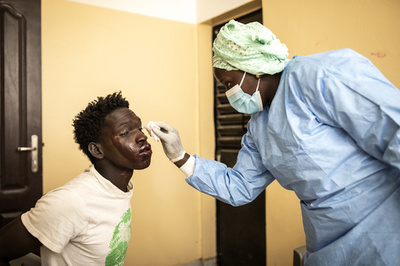 漁師ばかり300人超に謎の皮膚疾患、伝染報告はなし セネガル