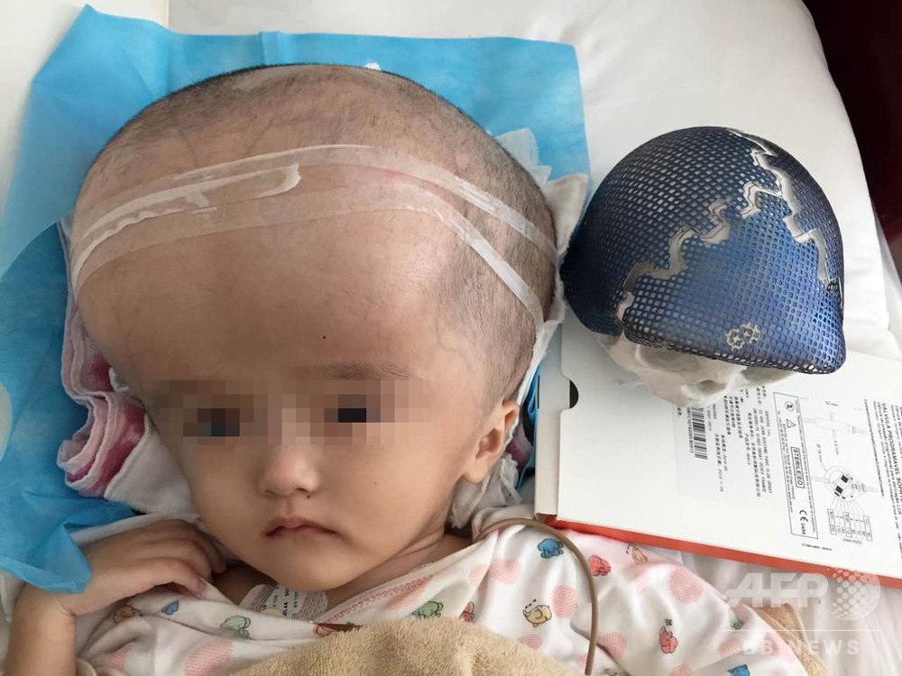 巨大な頭の赤ちゃん 事件再び ミルク代わりの固体飲料が原因か 中国 湖南省 写真1枚 国際ニュース Afpbb News