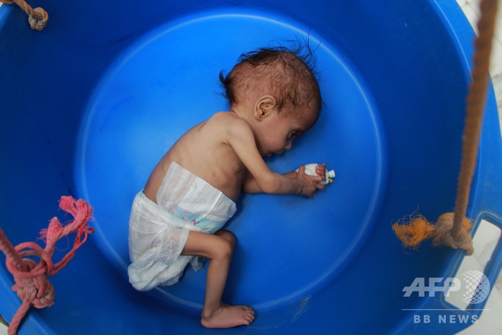 国際ニュース：AFPBB News子どもたち襲う飢餓、イエメン内戦が強いた犠牲