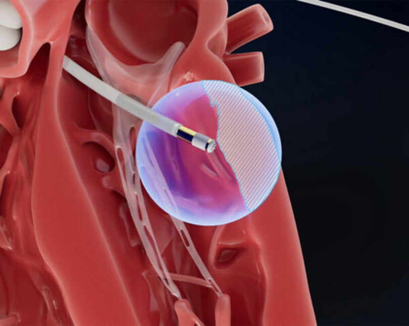 FIELD MEDICAL社、「HEART RHYTHM 2025」で瘢痕性VTにおける局所的Pfaのヒト初データを発表
