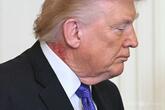 トランプ氏の首に赤い発疹 「予防的治療中」主治医