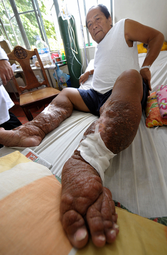 足が肥大したフィラリア症の男性、マニラ