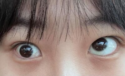 整形手術後に斜視発症…韓国・副作用を訴えた女性に“名誉毀損”で病院が反撃