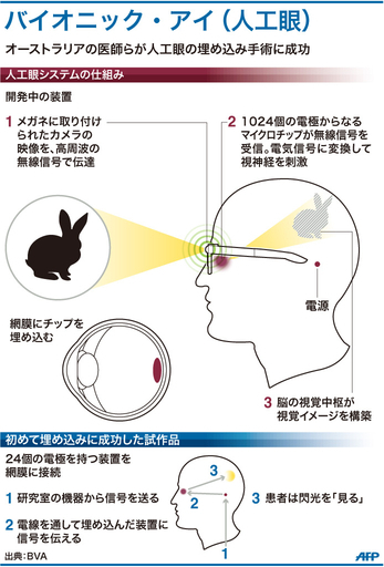 【図解】バイオニック・ビジョン・オーストラリアの人工眼