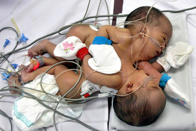 インドネシアで結合した双子