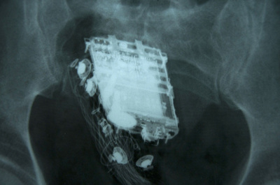 直腸に携帯電話隠した受刑者、着信音でばれる