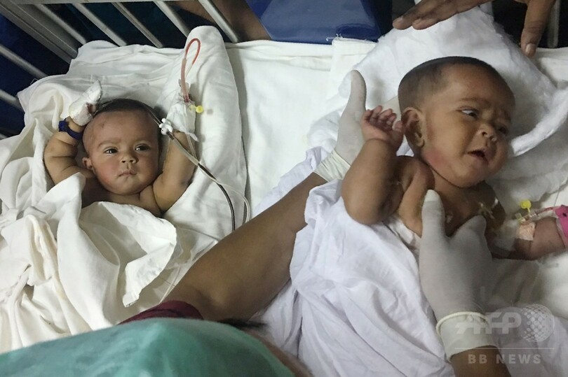 結合双生児の姉妹に分離手術 バングラデシュ初の手術成功 写真3枚 国際ニュース Afpbb News