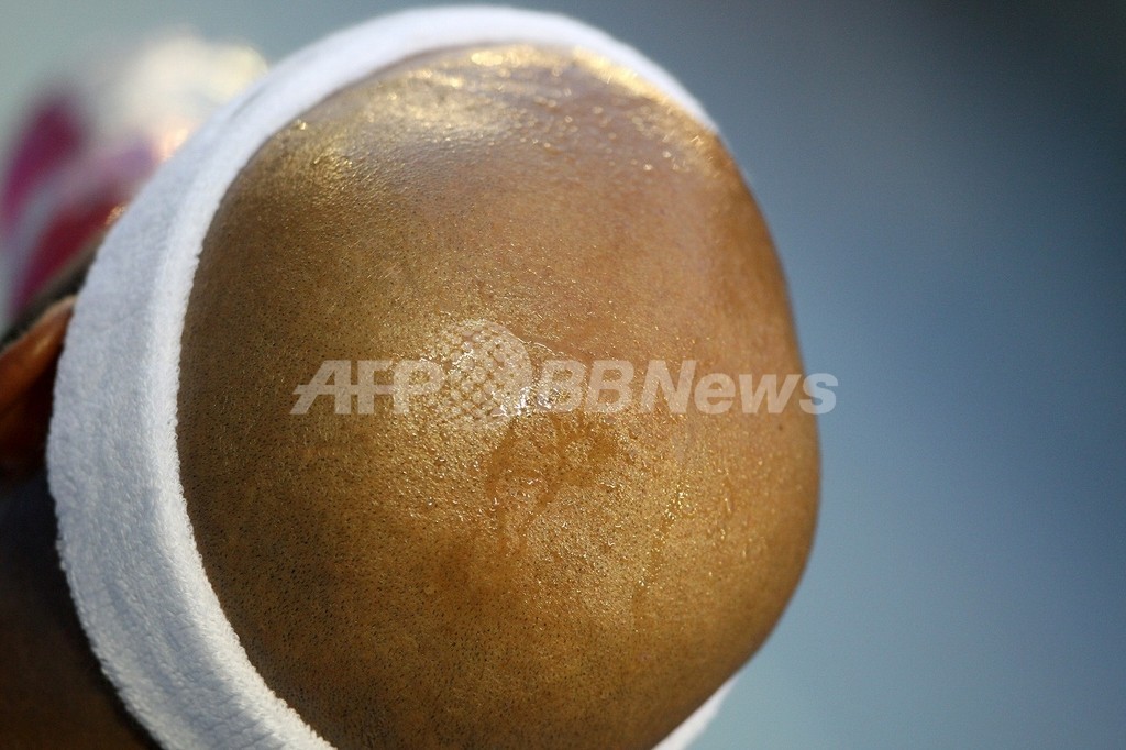 若はげの原因遺伝子を同定、将来は予防も可能に 北京の病院 若はげの原因遺伝子を同定、将来は予防も可能に 北京の病院