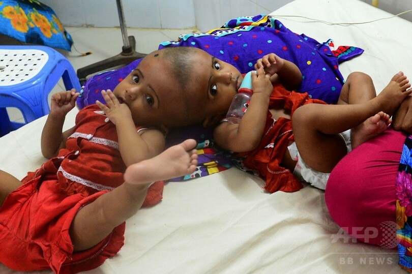 頭部結合の双子 分離手術へ 海外に支援要請 バングラデシュ 写真5枚 国際ニュース Afpbb News