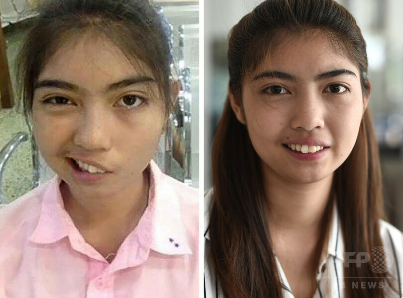 タイの女子高生 教師の暴力行為で顔面まひに 治療で笑顔を取り戻す 写真4枚 国際ニュース Afpbb News タイの女子高生 教師の暴力行為で顔面まひに 治療で笑顔を取り戻す 写真4枚 国際ニュース Afpbb News