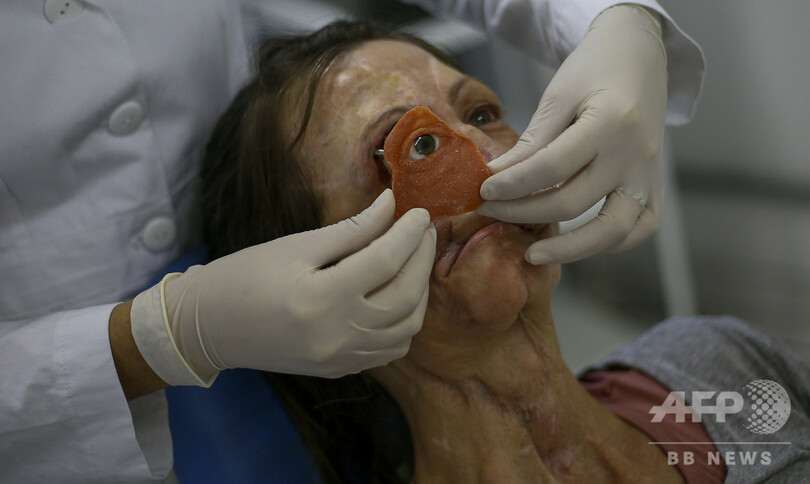 顔面欠損の患者、安価な「新たな顔」を3Dプリンターで手に ブラジル