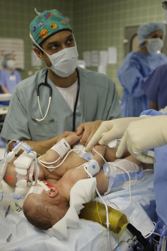 サウジで結合双生児の分離手術に成功、テレビで生中継