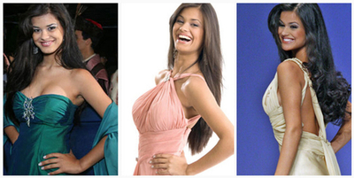 緑膿菌感染症で両手足切断のブラジル人モデルが死亡