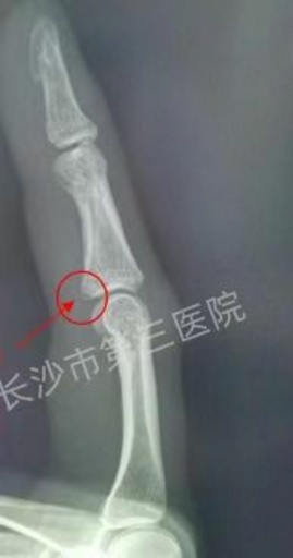 35歳の中国人女性 蚊をたたいてなんと骨折