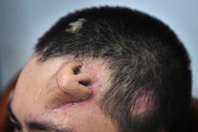 患者の額で「鼻」を培養、移植手術へ 中国・福建省