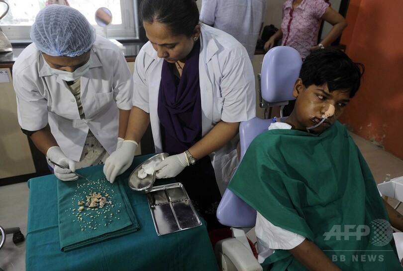 17歳少年から計232本の「歯」を摘出、インド