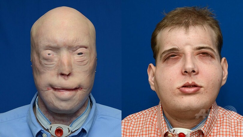 史上最も複雑な顔面移植手術、消防団員の男性に実施 米病院