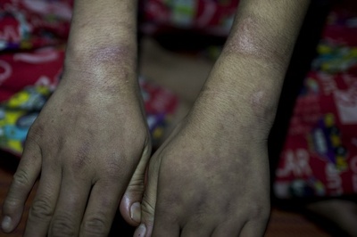 熱湯かけられ、傷口に唐辛子…児童労働の悪夢 ミャンマー