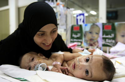 結合体双生児のモロッコ人姉妹、サウジで分離手術成功