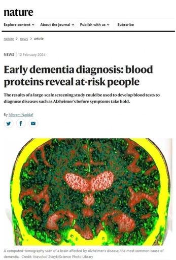 中国人による研究成果 アルツハイマー症などの早期対応・早期治療に希望