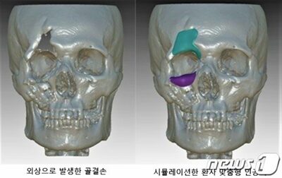 顔の骨も「3Dプリンター」で作る時代…韓国チーム、損傷部位の移植に成功
