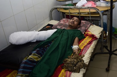 バングラデシュの「樹木男」、イボの除去手術成功